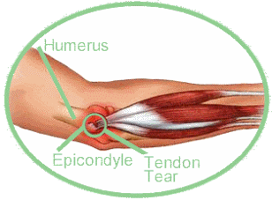 Tennis Elbow Anatomy